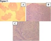 Graphical Abstract of Synovial chondromatosis caused mechanical snapping elbow: a case report
